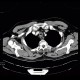 Stenosis of trachea, tracheal intubation: CT - Computed tomography